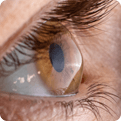 Eye that has damage to the cornea and needs treatment
