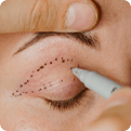 Eyelid getting marketing for eyelid surgery