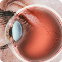 Eye that needs a retinal treatment