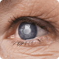 Eye that has a cataract because it hasn't had cataract removal surgery
