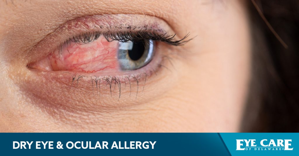 Newark Dry Eye & Ocular Allergy Treatment Center Eye Care of Delaware