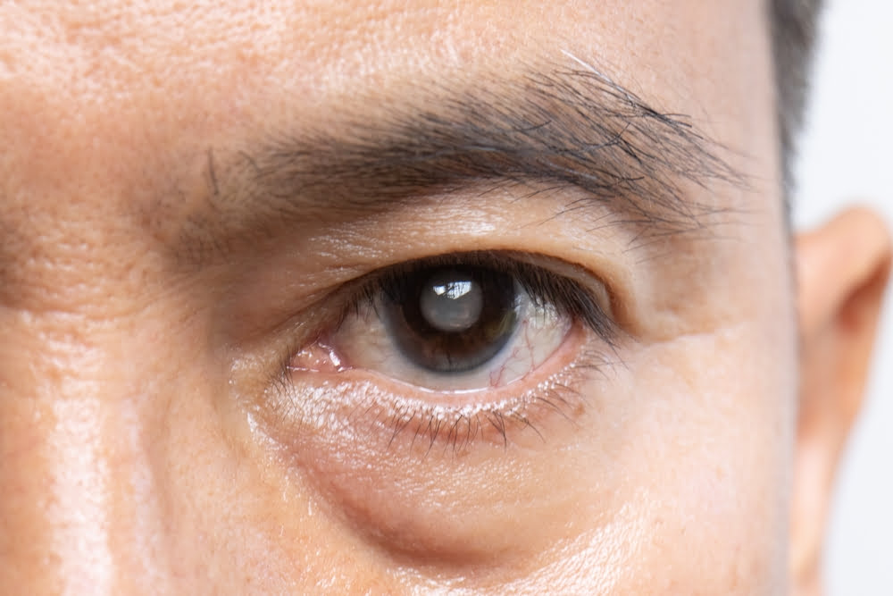 Newark cataract surgery.